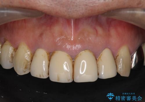 老朽化した前歯のクラウンやりかえの治療前