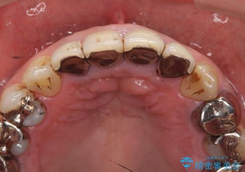 老朽化した前歯のクラウンやりかえの治療前