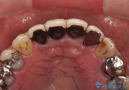 老朽化した前歯のクラウンやりかえの治療前