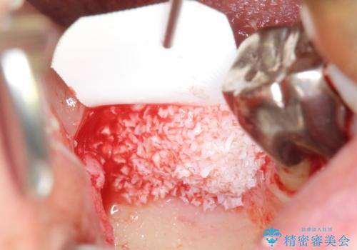 骨が少なくインプラントできないと言われた　下の奥歯のインプラント　60代男性の治療中
