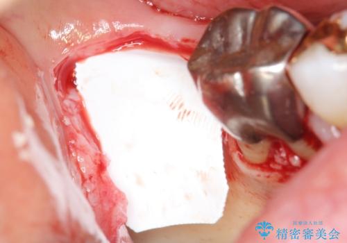 骨が少なくインプラントできないと言われた 下の奥歯のインプラント 60代男性の治療中