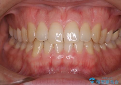 フロスが通せない PMTCで本来の歯のすき間にの治療前