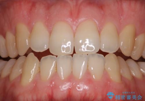 フロスが通せない　PMTCで本来の歯のすき間にの症例 治療前