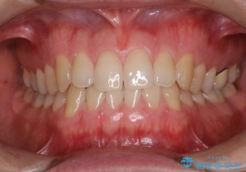 フロスが通せない PMTCで本来の歯のすき間にの治療後