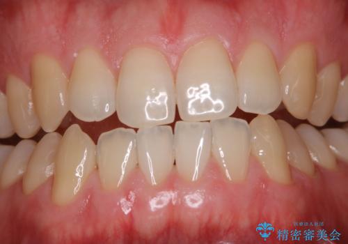 フロスが通せない　PMTCで本来の歯のすき間にの症例 治療後