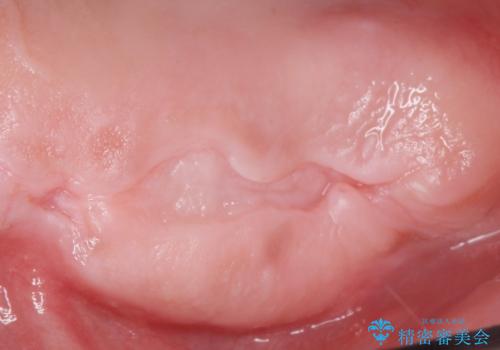 骨が薄く難しい上の奥歯のインプラント 50代男性の治療前