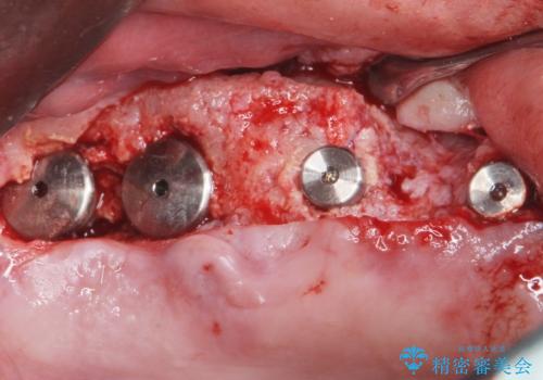 骨が薄く難しい上の奥歯のインプラント 50代男性の治療中