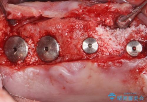 骨が薄く難しい上の奥歯のインプラント　50代男性