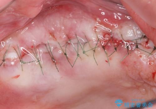 骨が薄く難しい上の奥歯のインプラント 50代男性の治療中