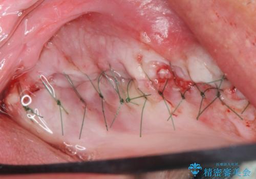 骨が薄く難しい上の奥歯のインプラント 50代男性の治療中