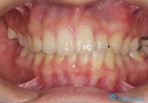 前歯のクロスバイトと抜歯が必要な奥歯の虫歯　インビザラインとインプラント治療の症例 治療前