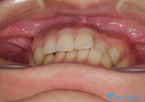 前歯のクロスバイトと抜歯が必要な奥歯の虫歯 インビザラインとインプラント治療の治療前