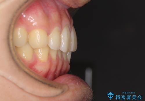 前歯のクロスバイトと抜歯が必要な奥歯の虫歯 インビザラインとインプラント治療の治療前