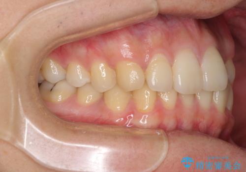 前歯のクロスバイトと抜歯が必要な奥歯の虫歯 インビザラインとインプラント治療の治療前