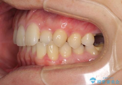 前歯のクロスバイトと抜歯が必要な奥歯の虫歯 インビザラインとインプラント治療の治療前