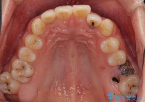 前歯のクロスバイトと抜歯が必要な奥歯の虫歯 インビザラインとインプラント治療の治療前