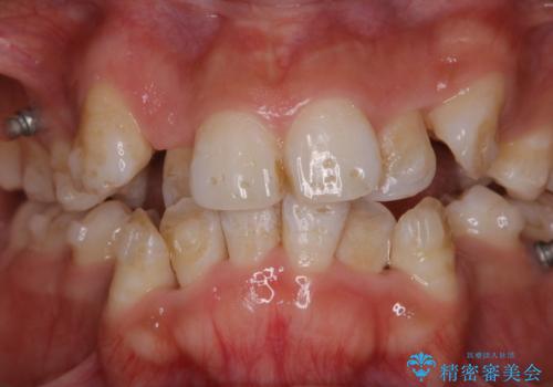 インビザラインで矯正中のコーヒーによる着色をきれいに除去の治療前