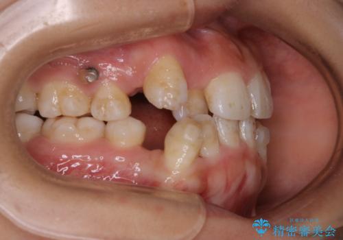 インビザラインで矯正中のコーヒーによる着色をきれいに除去の治療前