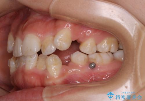 インビザラインで矯正中のコーヒーによる着色をきれいに除去の治療前