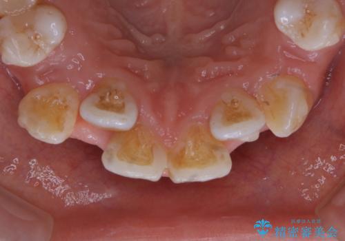 インビザラインで矯正中のコーヒーによる着色をきれいに除去の治療前