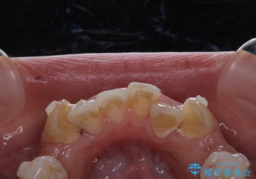 インビザラインで矯正中のコーヒーによる着色をきれいに除去の治療前