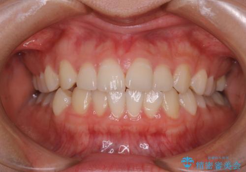 前歯のがたつきをインビザラインで治療の症例 治療前