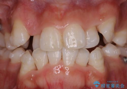 インビザラインで矯正中のコーヒーによる着色をきれいに除去の治療後