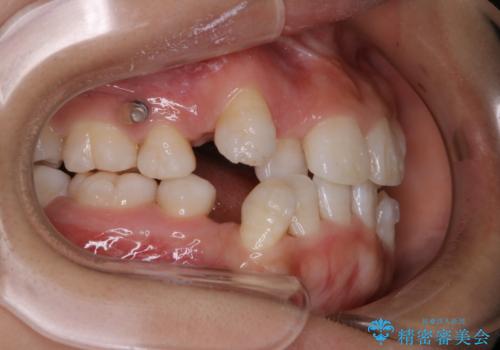 インビザラインで矯正中のコーヒーによる着色をきれいに除去の治療後