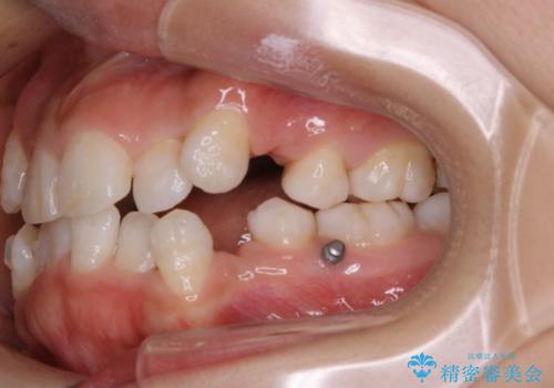 インビザラインで矯正中のコーヒーによる着色をきれいに除去の治療後