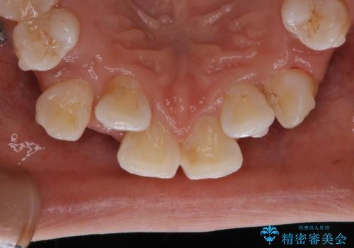 インビザラインで矯正中のコーヒーによる着色をきれいに除去の治療後