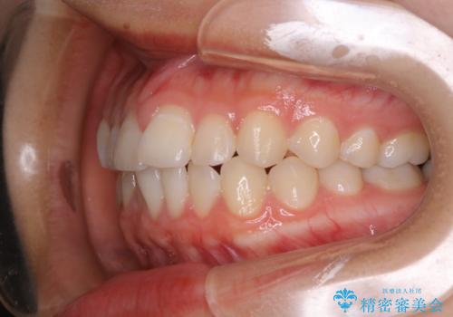 前歯のがたつきをインビザラインで治療の治療前