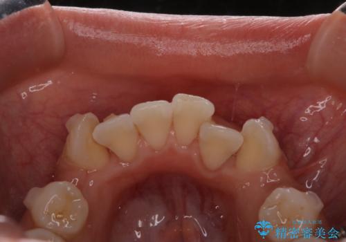 インビザラインで矯正中のコーヒーによる着色をきれいに除去の治療後