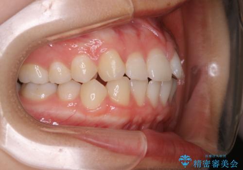 前歯のがたつきをインビザラインで治療の治療前