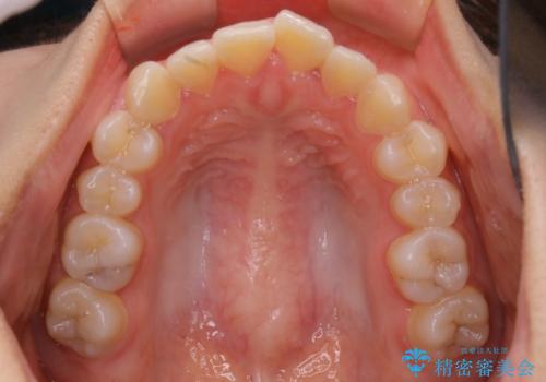 前歯のがたつきをインビザラインで治療の治療前