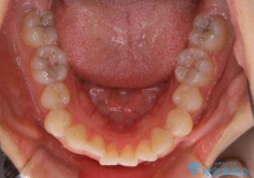 前歯のがたつきをインビザラインで治療の治療前