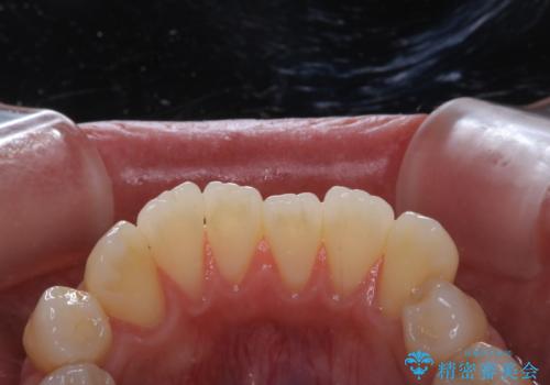 歯のクリーニングで歯周病の予防の治療前