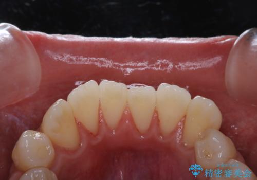 歯のクリーニングで歯周病の予防の治療後