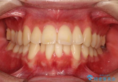 口元が出てるの気になる ハーフリンガルによる抜歯矯正での横顔改善の治療前