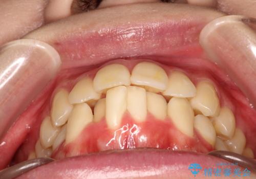 口元が出てるの気になる ハーフリンガルによる抜歯矯正での横顔改善の治療前