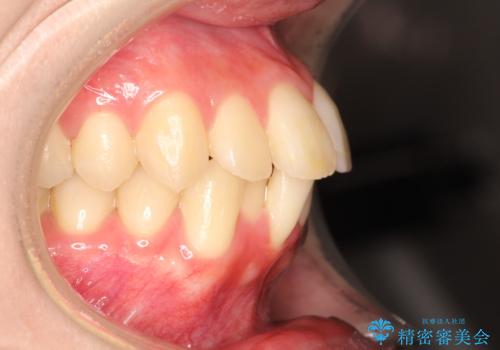 口元が出てるの気になる ハーフリンガルによる抜歯矯正での横顔改善の治療前