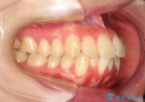 口元が出てるの気になる ハーフリンガルによる抜歯矯正での横顔改善の症例 治療前