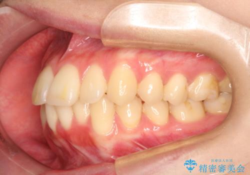 口元が出てるの気になる ハーフリンガルによる抜歯矯正での横顔改善の治療前