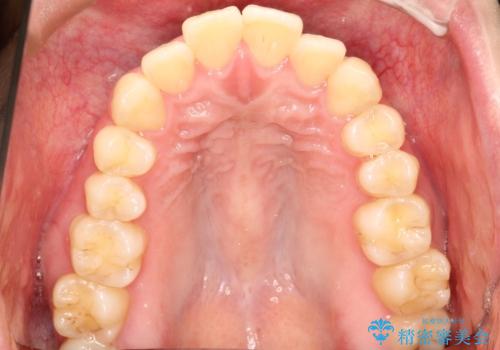 口元が出てるの気になる ハーフリンガルによる抜歯矯正での横顔改善の治療前