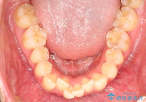 口元が出てるの気になる ハーフリンガルによる抜歯矯正での横顔改善の治療前