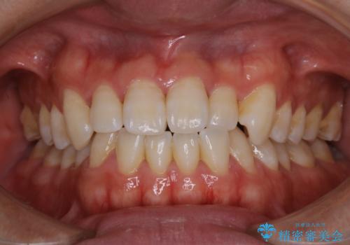 歯医者でホワイトニング　1日で白い歯にの症例 治療前