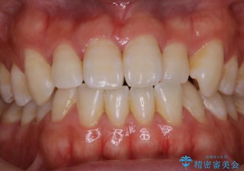 歯医者でホワイトニング 1日で白い歯にの治療前