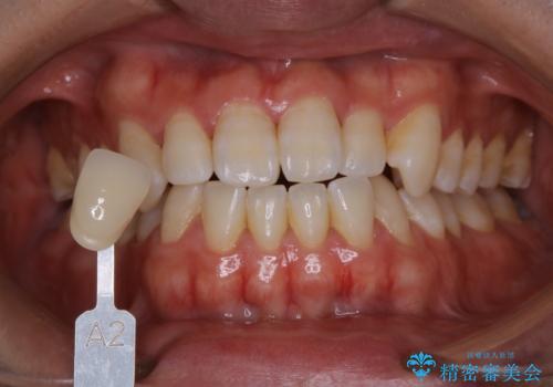 歯医者でホワイトニング 1日で白い歯にの治療前