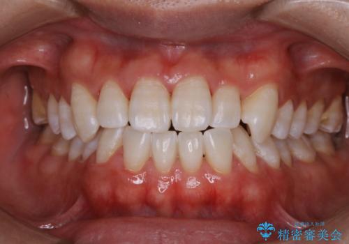 歯医者でホワイトニング　1日で白い歯にの症例 治療後