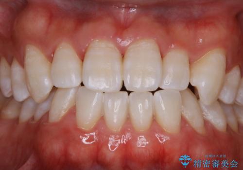 歯医者でホワイトニング 1日で白い歯にの治療後