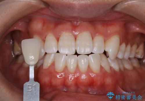 歯医者でホワイトニング　1日で白い歯にの治療後
